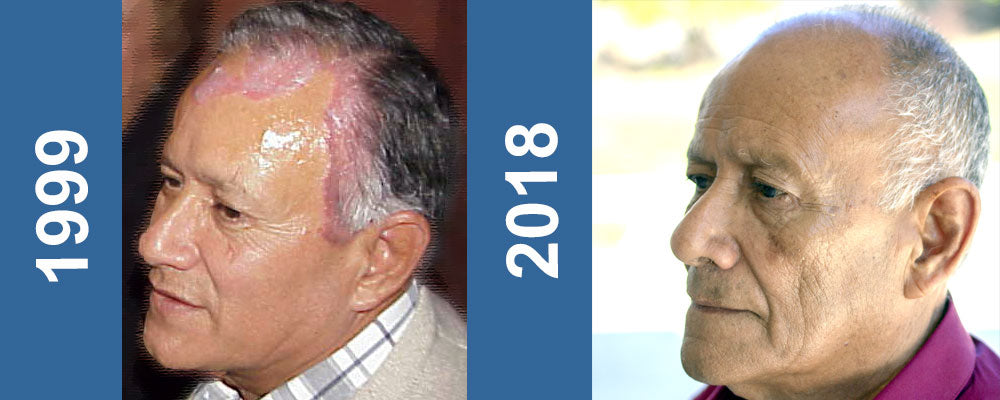 before and after picture of the founder with and without psoriasis Nopsor